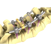 pine ii opfix plus脊柱內固定系統(tǒng)
