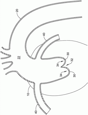 經(jīng)導(dǎo)管主動脈瓣膜系統(tǒng)EVOLUTPRO-23-US