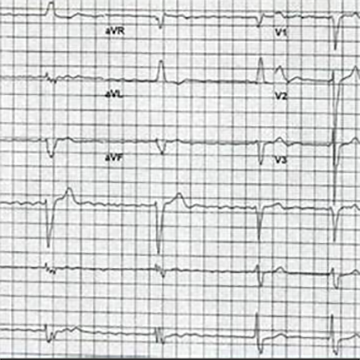 ecg app移動(dòng)心電圖房顫提示軟件